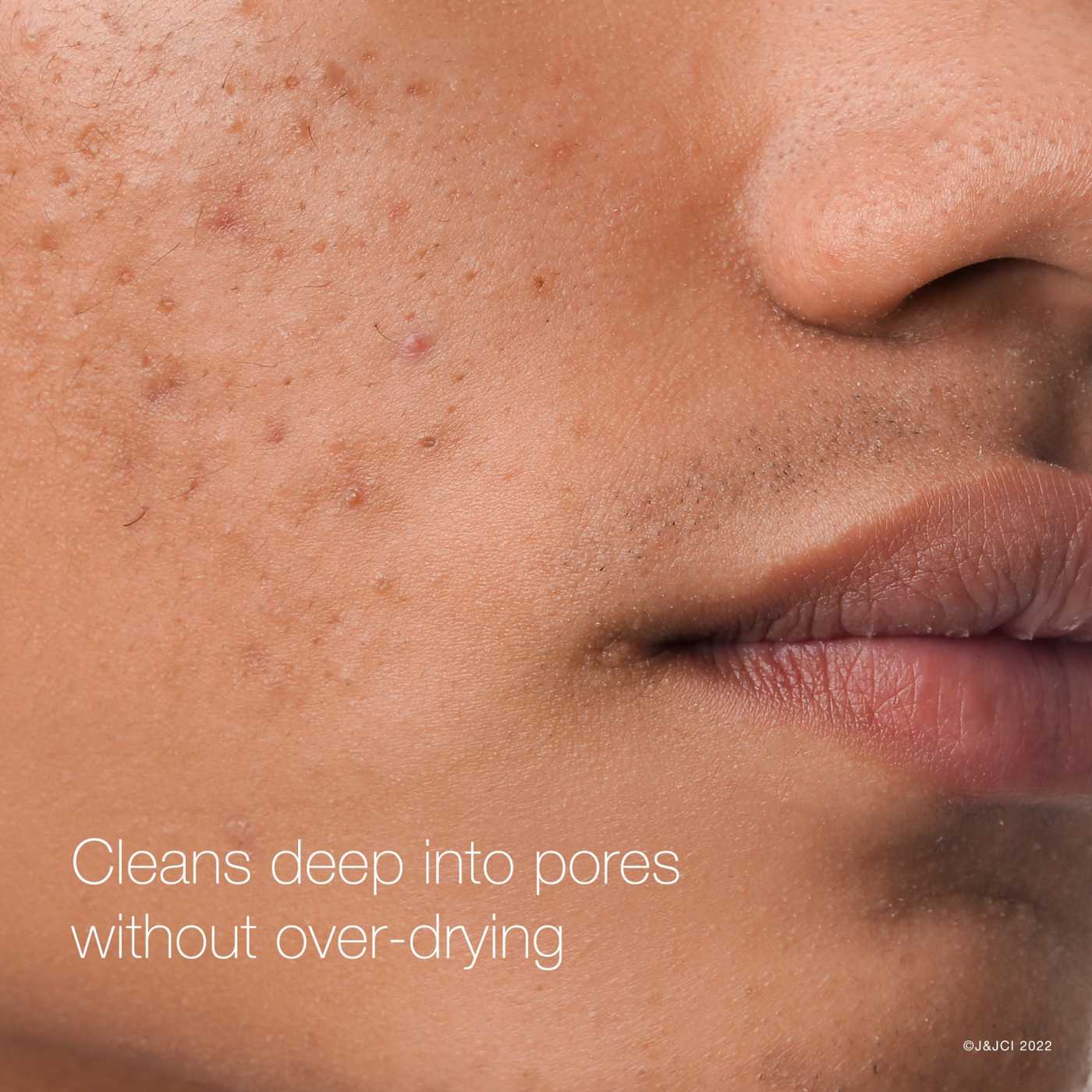 Neutrogena Rapid Clear Maximum Strength Acne Treatment Pads; image 5 of 8