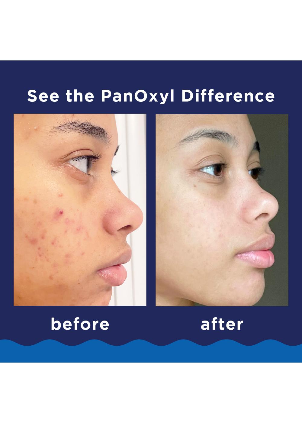 PanOxyl Face & Body Maximum Strength Acne Foaming Wash; image 6 of 10