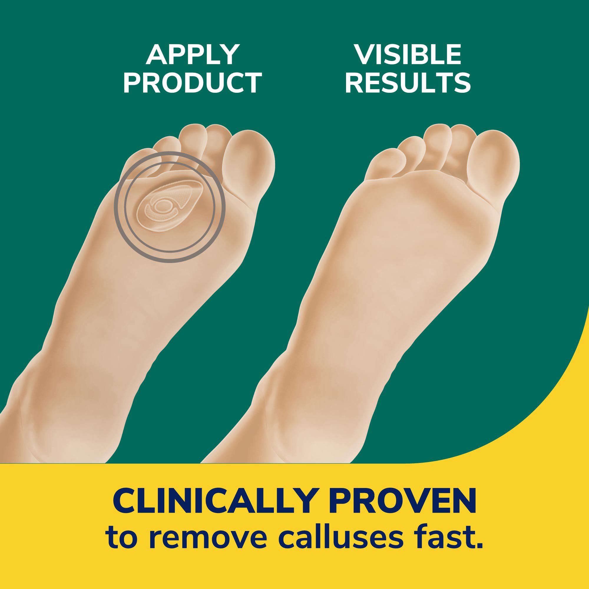 Dr. Scholl's Callus Removers - Shop Foot Care at H-E-B