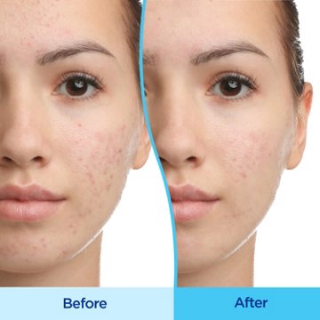 Differin Gel Acne Treatment 0.1% Adapalene Pump