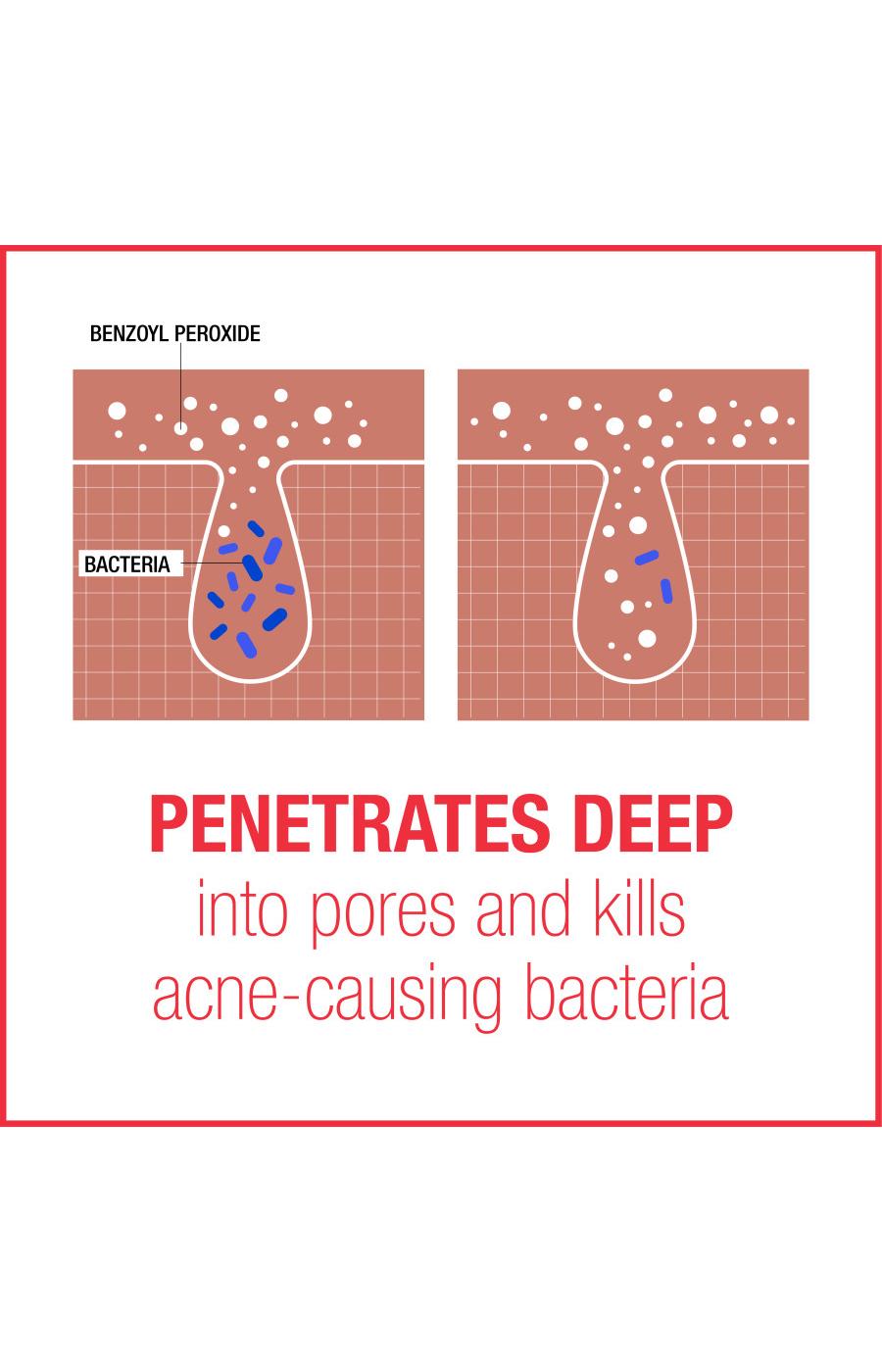 Neutrogena Stubborn Acne Am Treatment; image 6 of 8