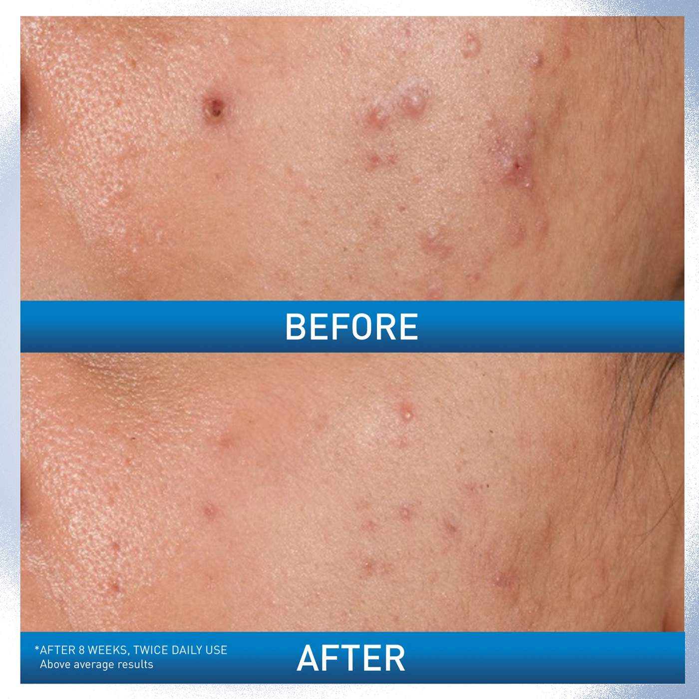 CeraVe Acne Control Gel; image 2 of 9