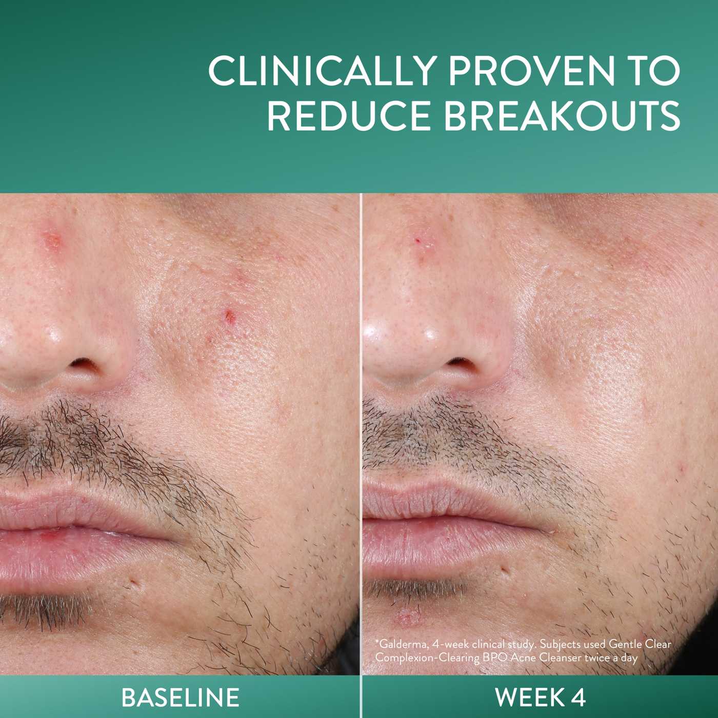 Cetaphil Gentle Clear Complexion-Clearing BPO Acne Cleanser; image 3 of 4