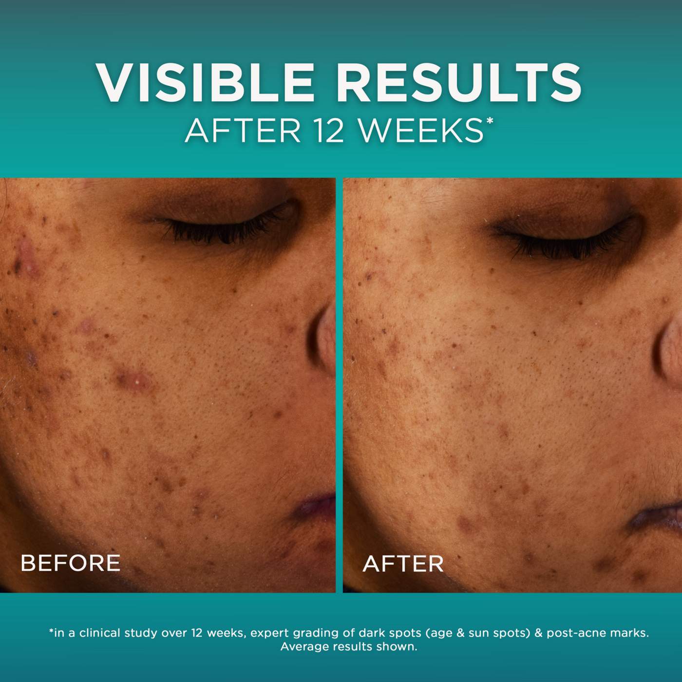 L'Oréal Paris Bright Reveal 12 Percent Niacinamide Dark Spot Serum; image 5 of 7