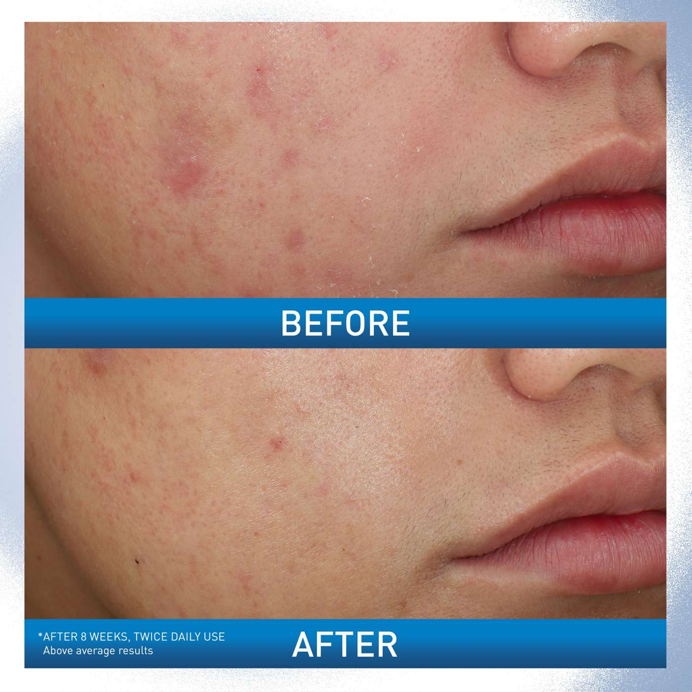 CeraVe Acne Foaming Cream Wash; image 2 of 10