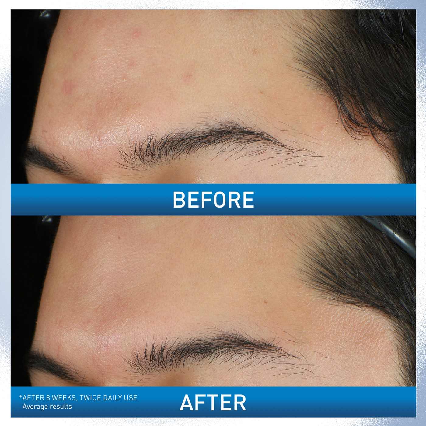 CeraVe Acne Foaming Cream Wash; image 5 of 10