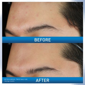 CeraVe Acne Foaming Cream Wash