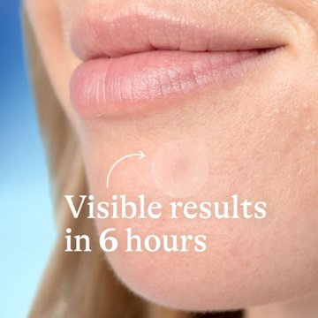 Differin Acne-Prone Skin Patches
