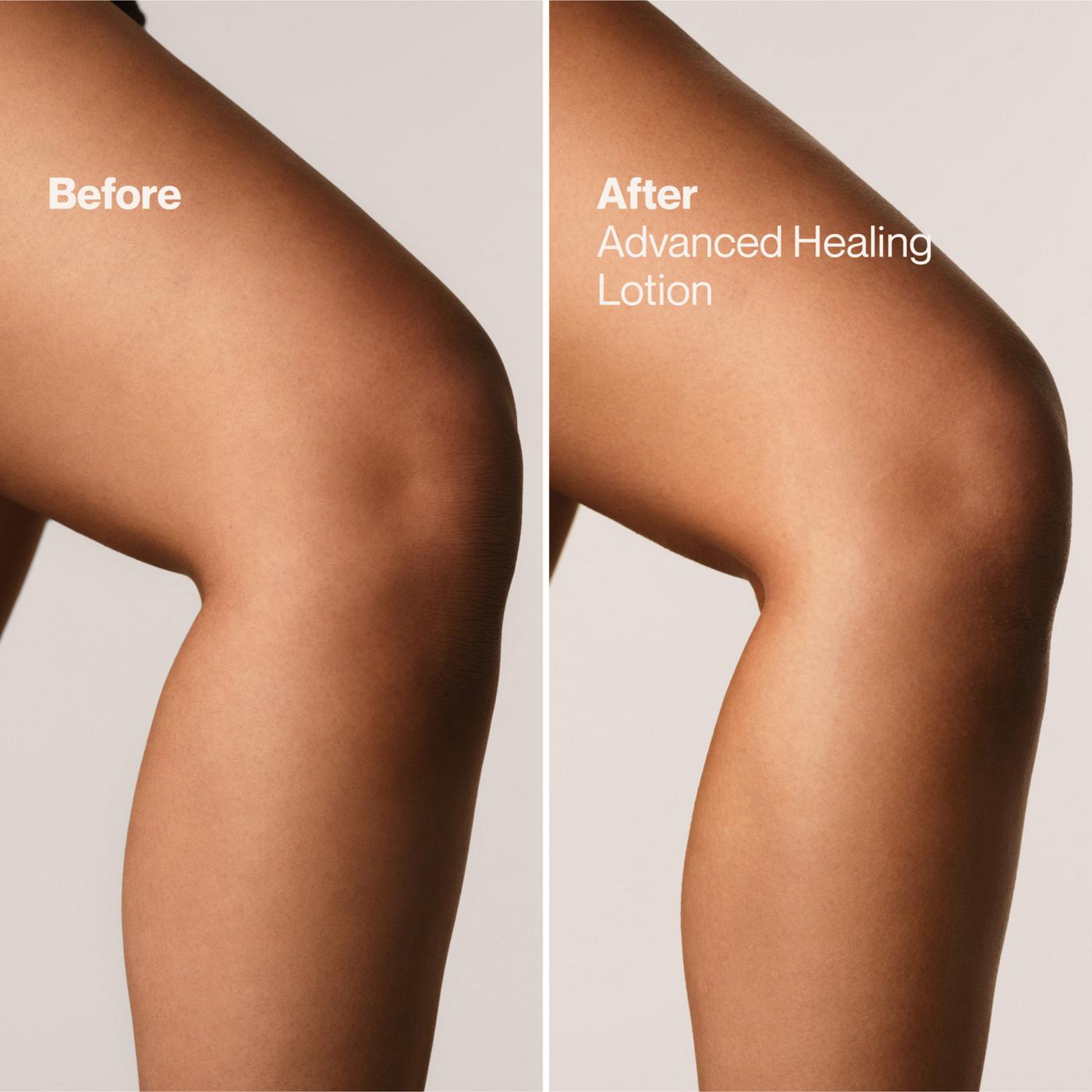 Suave Advanced Healing Hand & Body Lotion with Ceramides - Extra Dry Skin; image 8 of 9