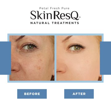 Petal Fresh Skin ResQ Nighttime Pimple Patches