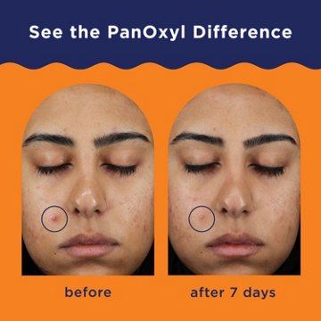 Panoxyl Maximum Strength Acne Clearing Spot Treatment